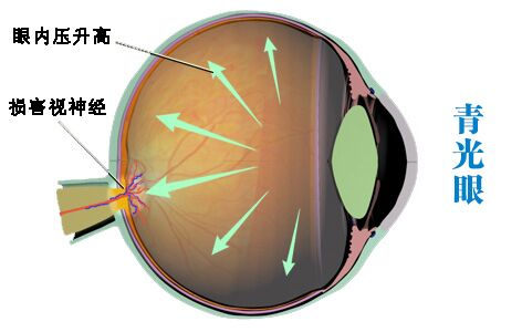 青光眼做手术有哪些利弊