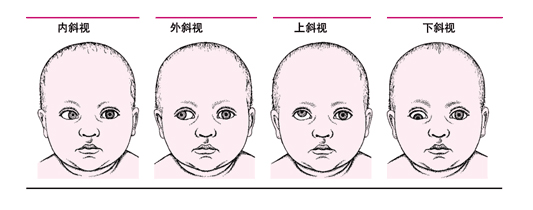 兰州儿童眼病专家：孩子常常歪脖子可能是斜视