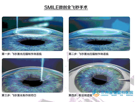 兰州全飞秒激光近视手术无瓣(smile)技术