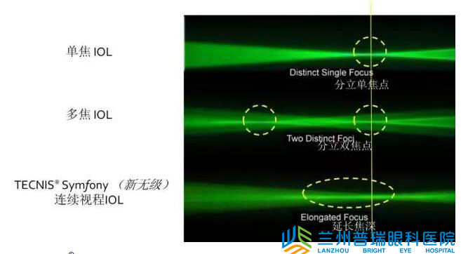 兰州眼科医院成功实施新无极变焦晶体植入术