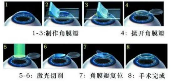 准分子激光手术到底是怎么治 愈你的眼睛的？