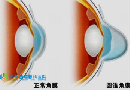 有圆锥角膜做不了近视手术怎么矫正视力