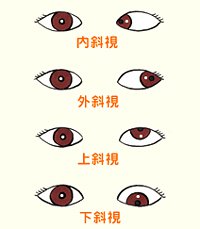 斜视检查之注视性质分类及检查方法