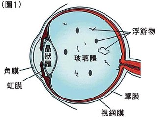 高度近视怎么办?视网膜脱落能吗?