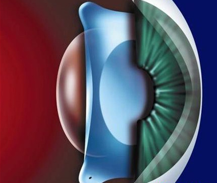ICL晶体植入矫正高度近视手术如同在眼内配戴隐形眼镜