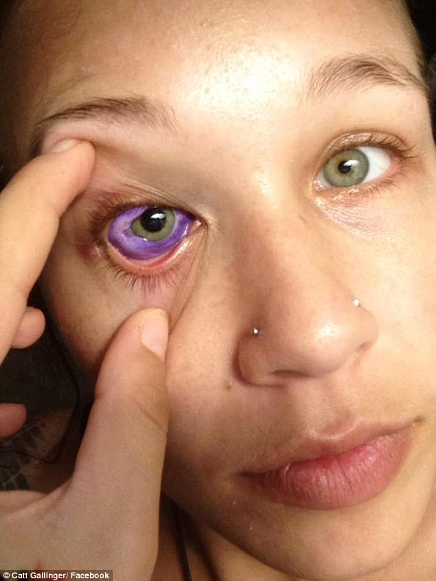 噩梦！加拿大女模做眼球纹身致失明损伤