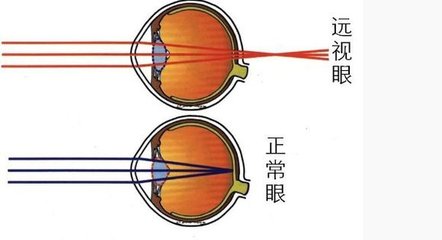 造成远视眼的病因病理