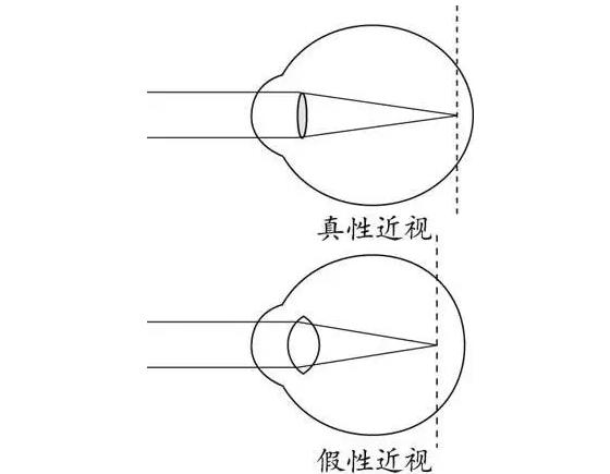 医学小方法：检测真性近视还是假性近视