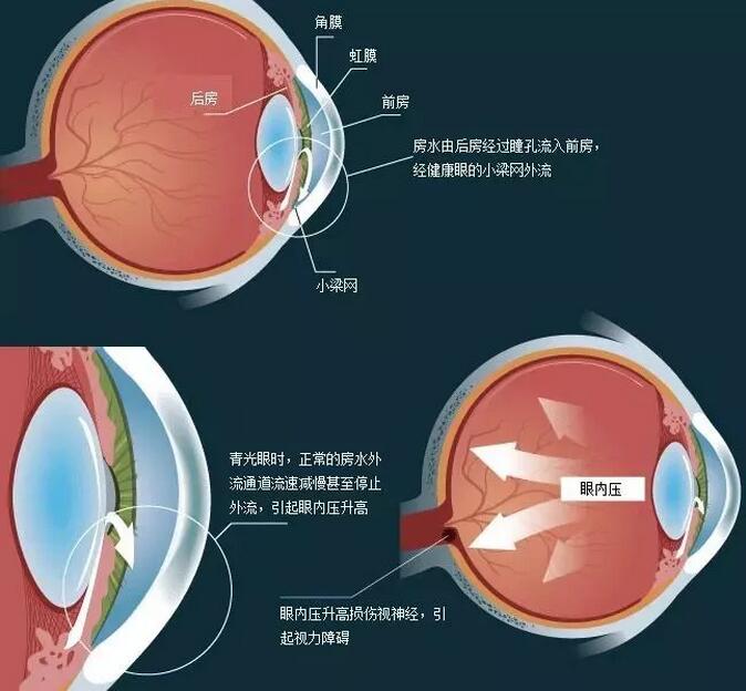 3.6号世界青光眼日：警惕视力小偷!