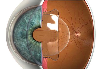 ICL高端近视眼矫正手术，适合角膜薄、高度近视