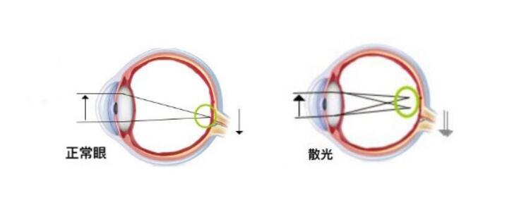 高度散光加近视可以做手术吗？