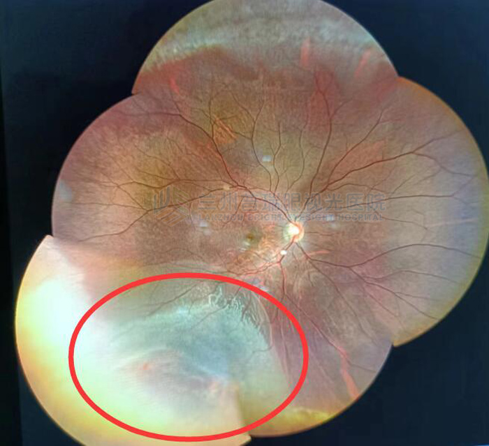 视网膜脱离原因有一种是高度近视