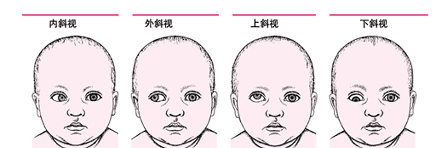 眼科医生告诉宝妈宝爸：如何预防幼儿斜视