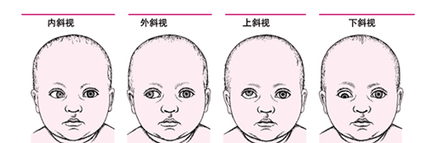 不同斜视不同矫治方法